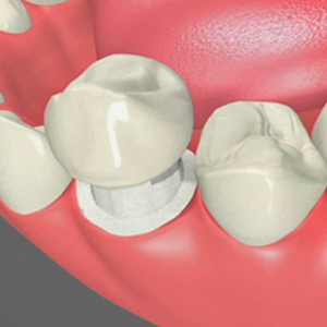 Dental Crowns